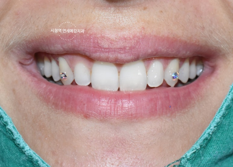 투쓰젬(Tooth gem),굳이 한다면 꼭 치과에서! 이유&비용,실제 치과에서 한 사진까지! 관련 이미지 6