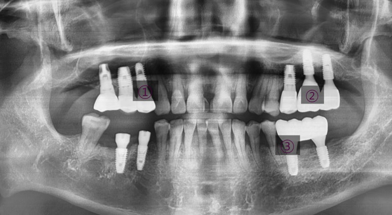 오래된 임플란트가 흔들려요 인플란트 재수술도 서울역가까운치과 연세예감치과 관련 이미지 3