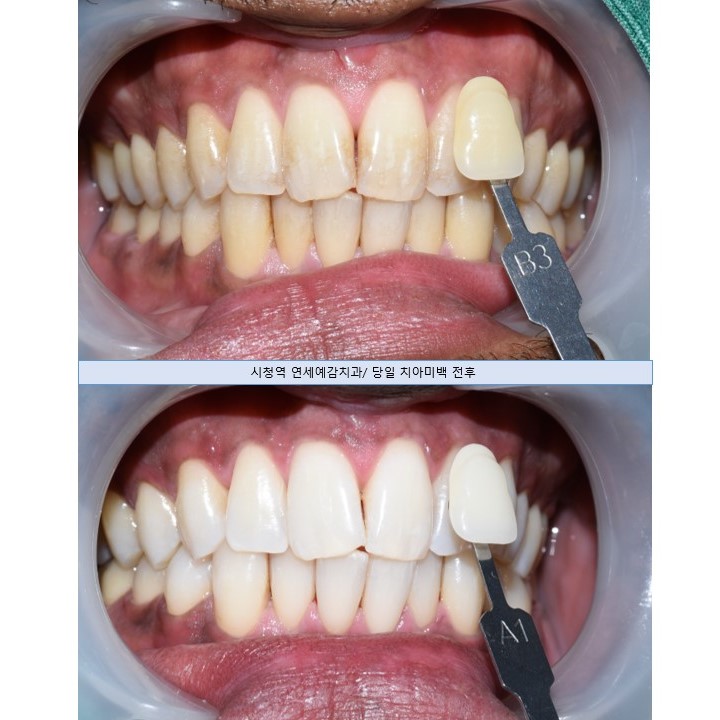 치아미백 유명한 치과, 외국인 관광객도 관광와서 하고 가는 치아미백 관련 이미지 8