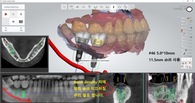마포 임플란트가 너무 무서워요 하는 분들 잇몸절개하지 않는 네비게이션임플란트 소개해드립니다 관련 이미지 18