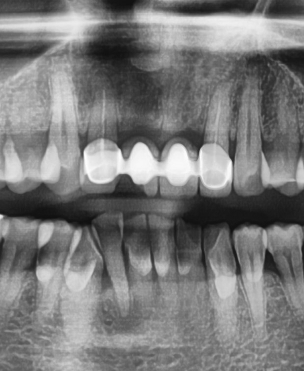 [치과브릿지]남대문치과/깨지고 오래된 앞니브릿지 교체케이스 관련 이미지 2
