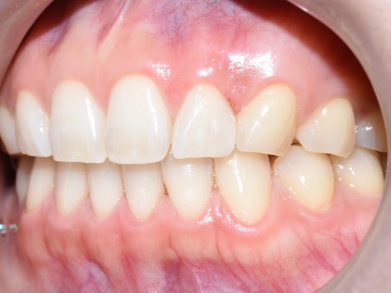 앞니 사이 벌어진 부위 레진치료의 방법 관련 이미지 5