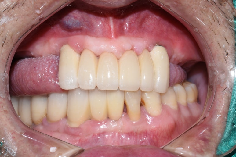 사용중인 틀니가 불편하다면? 임플란트와 틀니가 결합된 임플란트 틀니 추천 관련 이미지 19