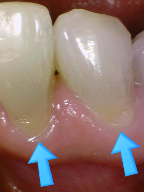 [을지로/명동 근처 치과] 앞니 레진 치료사례 관련 이미지 4