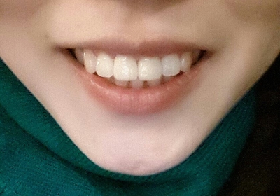 시청역치과 연세예감치과의 2번만의 내원으로 완성되는 고른앞니 만들기 케이스 소개 관련 이미지 7