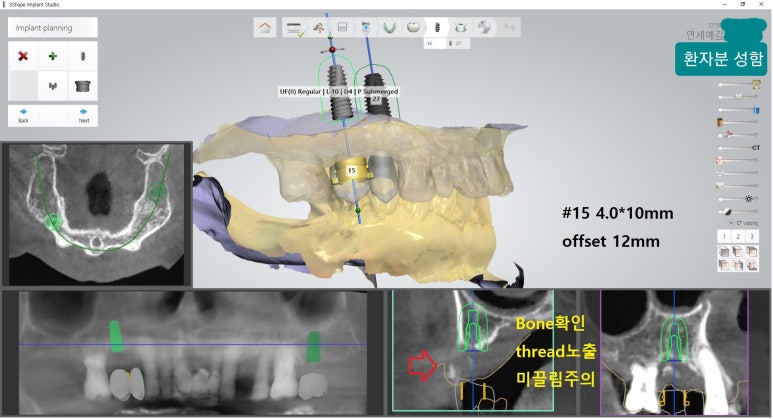 [시청역/을지로] 임플란트 진단 상담 비용? 관련 이미지 15