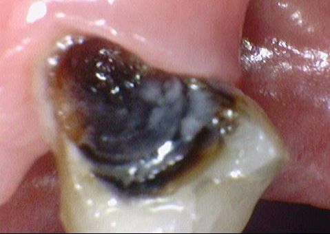 임플란트, 빼면서 바로 심을 수 있나요? (발치즉시 임플란트) 관련 이미지 2