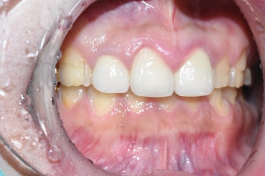 [시청역/광화문] 부식된 노란치아. 정말 하얀, 새하얀 치아로 만들고 싶어요 비용도 알려드려요 관련 이미지 3