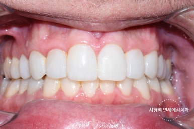 깨진 치아 레진치료 방법 실제사진 관련 이미지 7