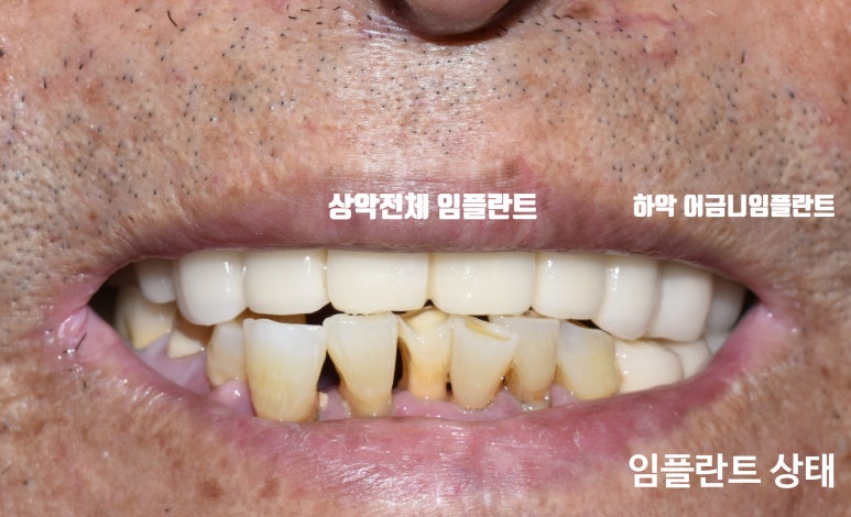 [시청역/서울역/광화문] 전체 임플란트 사례사진, 틀니대신 임플란트 관련 이미지 4