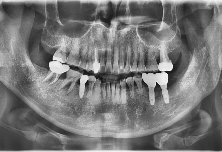 충정로 서울역 근처 고난도 & 재수술 임플란트 수술 치과 관련 이미지 12