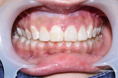 깨진 치아 레진치료 방법 실제사진 관련 이미지 9