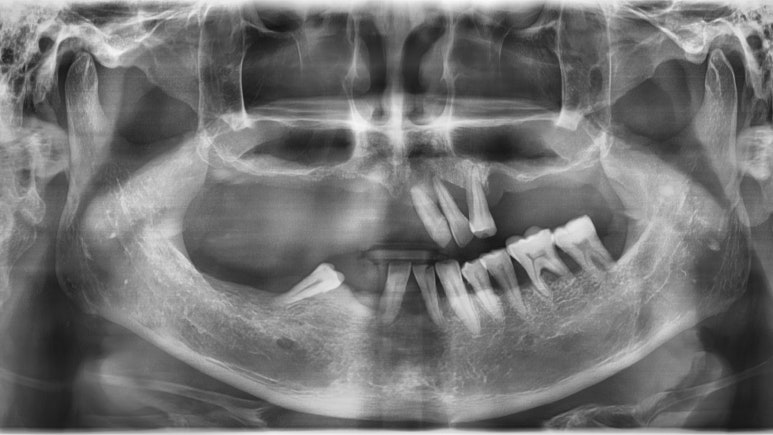 [남대문시장] 임플란트 조금 더 안아프고 간편하게 관련 이미지 2