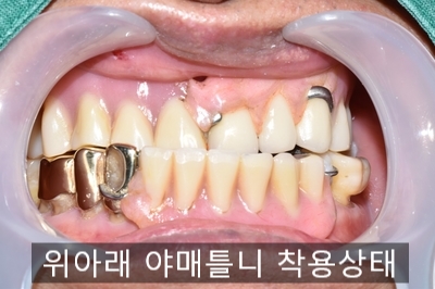 [종로/시청역]실제 환자의 보험 임플란트, 보험 틀니 사례 소개합니다. 젊어지는틀니,임플란트 치료 관련 이미지 1