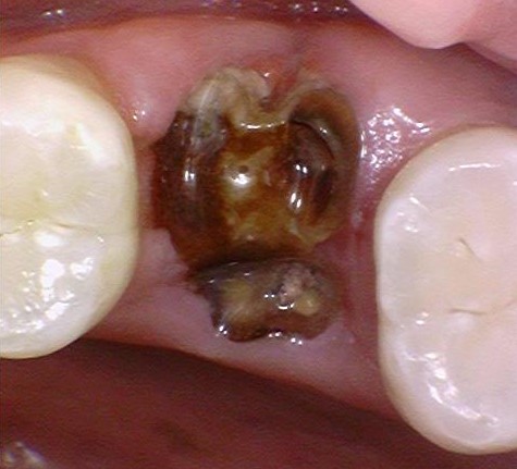 [서울시청역치과] 20대, 30대도 임플란트를 하나요?? +네비게이션임플란트안내 관련 이미지 1