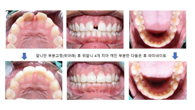 벌어진 앞니 치료, 하루에 가능, 실제케이스 및 가격 비용 관련 이미지 8
