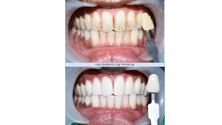 [해외에서도 찾아오는 서울시청역/치과미백]커피를 많이 마셔서 치아가 착색이 됐어요. 치아미백?? 관련 이미지 3