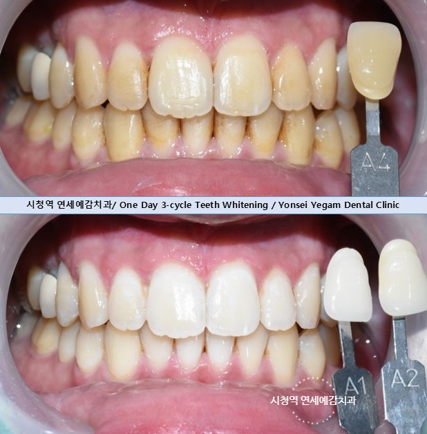 치아미백 시림? 해외관광객 외국인들도 미백하러 찾아오는 치과에서 알려드립니다 관련 이미지 3