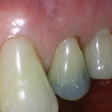 [서울/시청역]어금니 치아가 깨져서 크라운이 필요하다면? 관련 이미지 9
