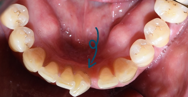 시청역 앞니교정 알아보겠습니다![실제 사례:앞니 하나가 점점 튀어나오고 벌어져요] 관련 이미지 2