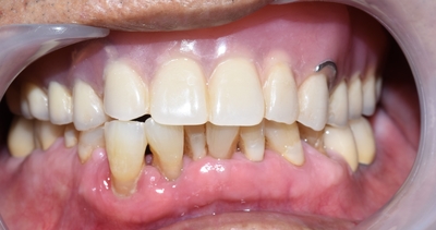 남대문시장가까운치과, 명동,서울역&용산가까운치과, 틀니치료 사례 관련 이미지 15