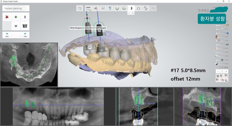 [시청역/을지로] 임플란트 진단 상담 비용? 관련 이미지 17