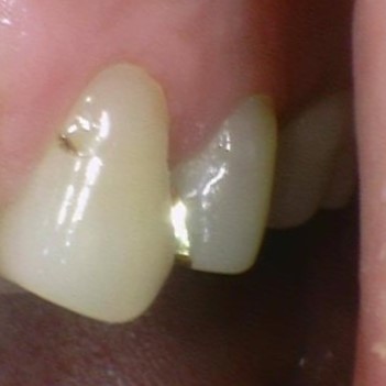 광화문 치료 치아에 까만 점이 생겼어요 관련 이미지 1