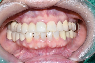 앞니 여러개 임플란트 잘하는 치과 서울역치과 실제사진 관련 이미지 5