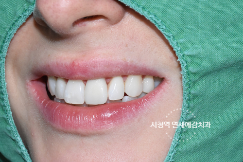 시청역 치과/ 신경이 죽은 치아의 변색 치료 위한 크라운 케이스&가격도 / 외국인 환자분이 눈물을 흘리셨어요 관련 이미지 5