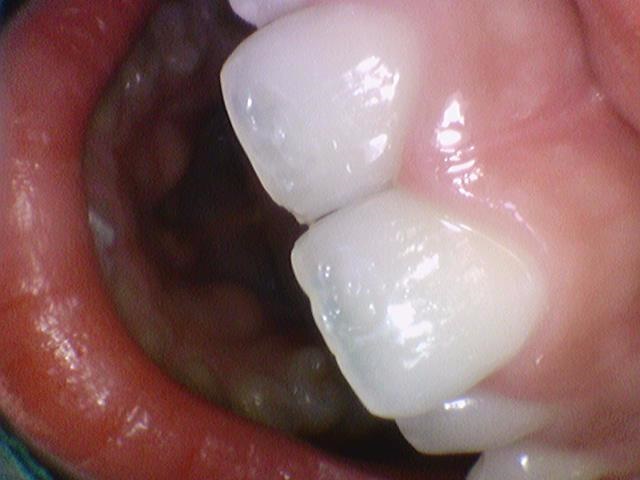 반점치, 반상치, 치아에 하얀 점 치료방법 전후사진, 가격 비용까지 관련 이미지 4