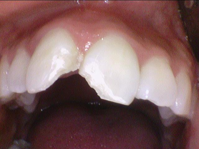 [시청역/서울역 치과] 앞니 치아부러짐 자연스럽게 치료사례 관련 이미지 1