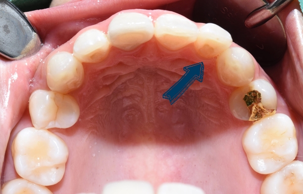 Q&A:"교정을 예전에 오래전에 했는데 앞니치아가 삐뚤어졌어요"해결방법은, 비용은? 관련 이미지 3