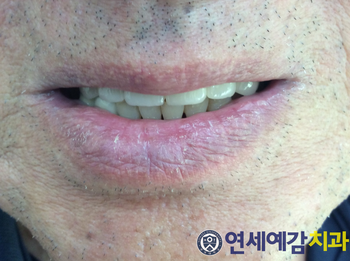 서울 틀니제작, 틀니치료 실제 예입니다. 시청역<연세예감치과> 관련 이미지 12