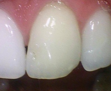 [광화문/치과] 외국인환자 변색된 앞니 하나의 크라운 치료 실제 케이스 관련 이미지 3