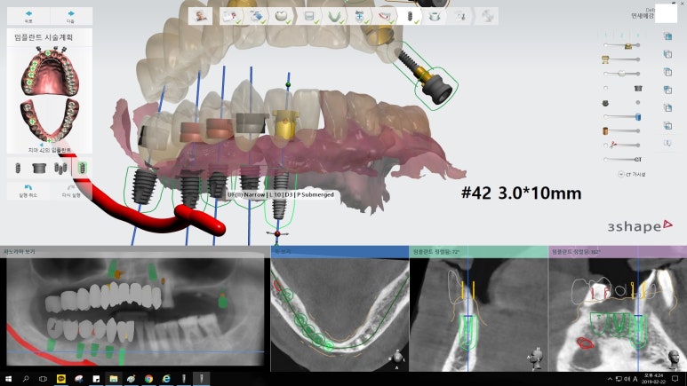 [남대문시장] 임플란트 조금 더 안아프고 간편하게 관련 이미지 10