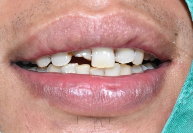 서울시청역 남대문 임플란트 대신에 앞니 브릿지를 한 케이스 관련 이미지 5