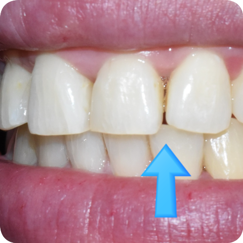 (교정 후에도) 벌어진 앞니 치아 레진으로 간단히 메꾸기 관련 이미지 1