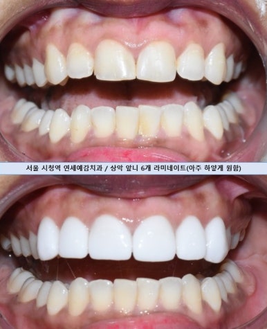 [서울/치과] 아주 하얀 앞니를 원한 외국인모델 환자분의 최소삭제 및 무삭제 라미네이트 사진과 가격공개 관련 이미지 1
