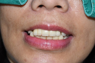 전체 임프란트를 하기 위해 홍콩에서 오신 홍콩인 환자분 관련 이미지 6