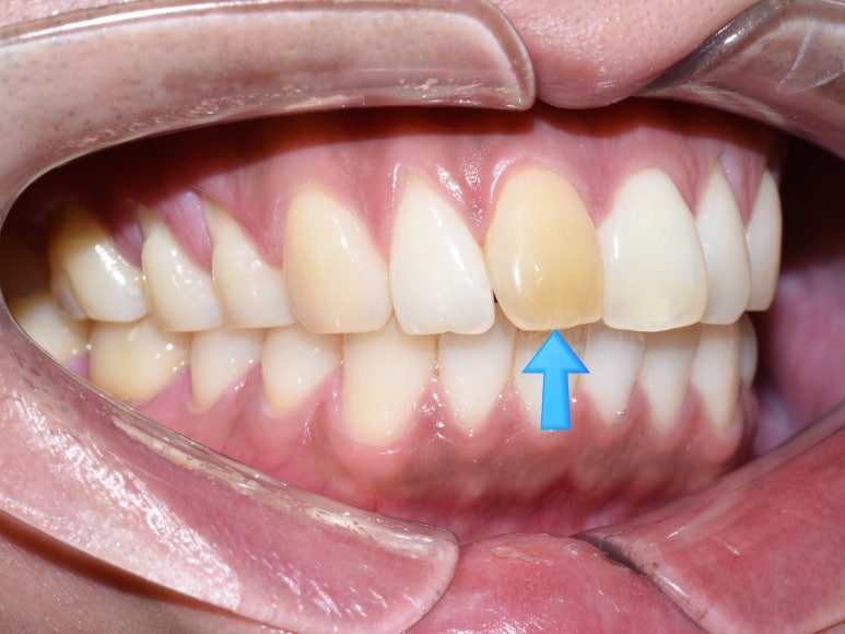 앞니가 변색이 있어서 크라운을 해야하는데 뒤에 교정 유지장치가 붙어있다면? 관련 이미지 1