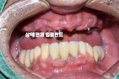 서울 중구 치과/이가 하나도 없는 환자의 치료방법/틀니, 풀아치임플란트, 전체 임플란트 등 관련 이미지 13