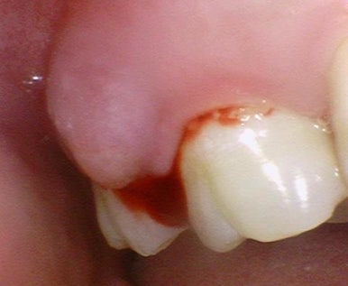 광화문 시청치과 치아가 쪼개졌어요 실제사례 관련 이미지 6