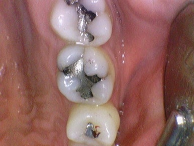 [을지로가까운치과]아말감충치 치료사례 아말감 주변 2차충치를 레진/인레이/크라운으로 치료 관련 이미지 4