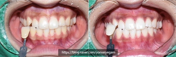 Yonsei Yegam Dental Clinic (City Hall Station, Seoul)-Teeth cleaning, Whitening Review 관련 이미지 14