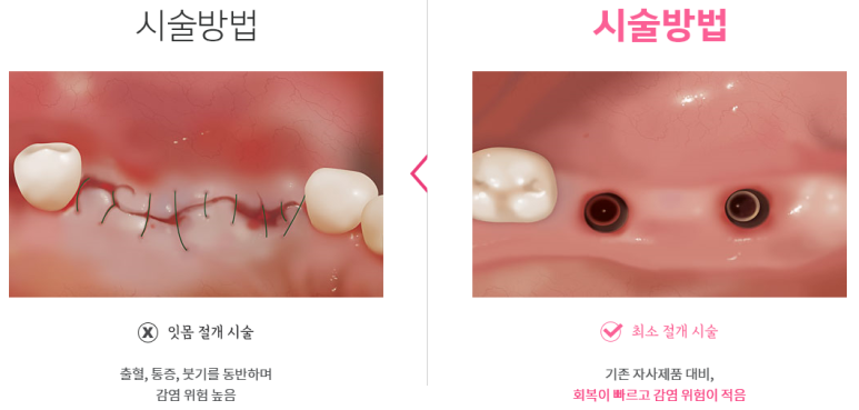 [서울시청역치과] 20대, 30대도 임플란트를 하나요?? +네비게이션임플란트안내 관련 이미지 5