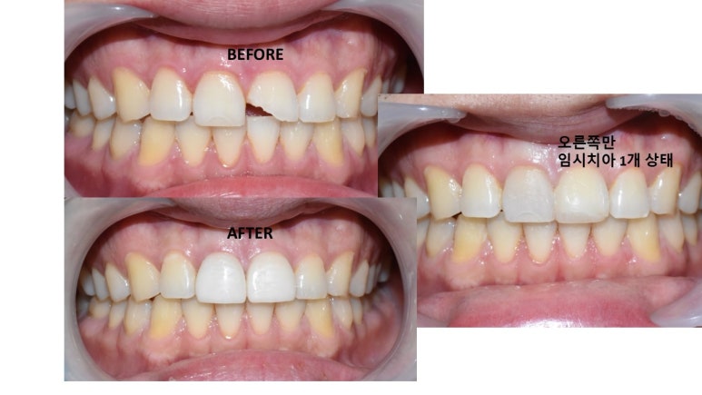 라미네이트 2개이상시 개당 50만원(부가세별도) 깨진 앞니 최소삭제한 라미네이트 케이스 관련 이미지 5