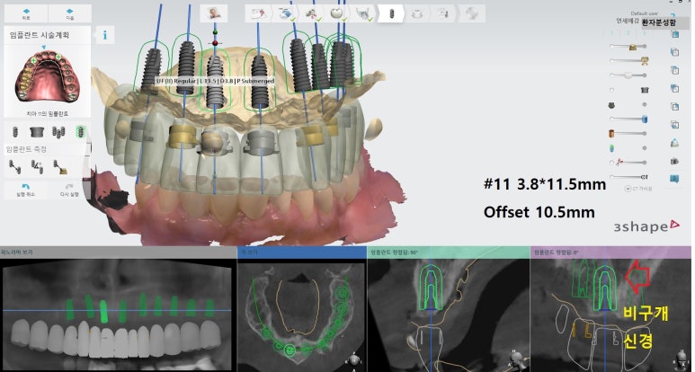 시청역 광화문  최소절개 또는 비절개로 가능한 네비게이션 임플란트 유명한 치과 내비게이션소개드려요 관련 이미지 6