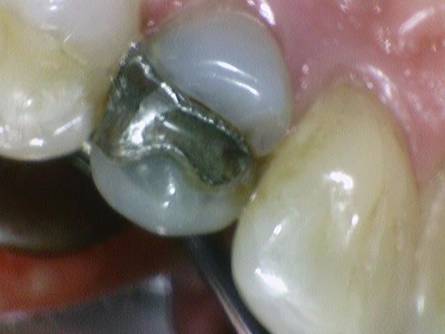 시청역치과, 신경치료 하고 크라운 꼭 해야하나요? 관련 이미지 5