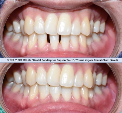앞니사이벌어짐, 레진으로 메울 수 있을까? 비용,가격까지. 종로치과/광화문 치과 관련 이미지 3