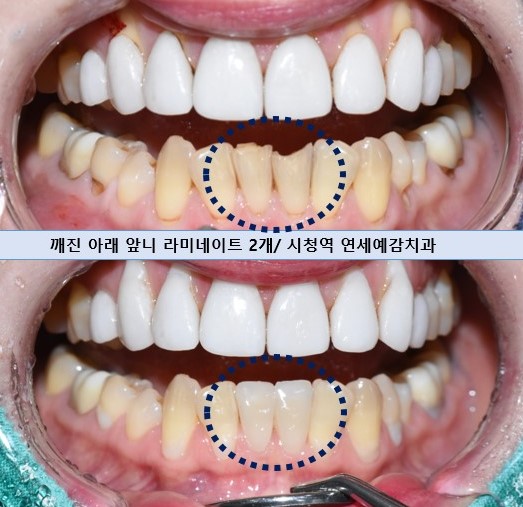 라미네이트 2개이상시 개당 50만원(부가세별도) 깨진 앞니 최소삭제한 라미네이트 케이스 관련 이미지 3